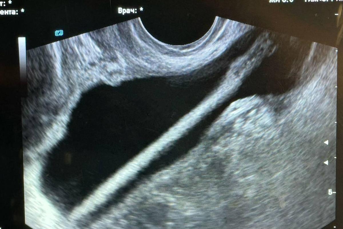 Подмосковные медики извлекли карандаш из мочевого пузыря пациентки