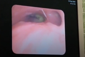 Двум школьникам в Ленобласти спасли легкие, удалив инородные тела из бронхов