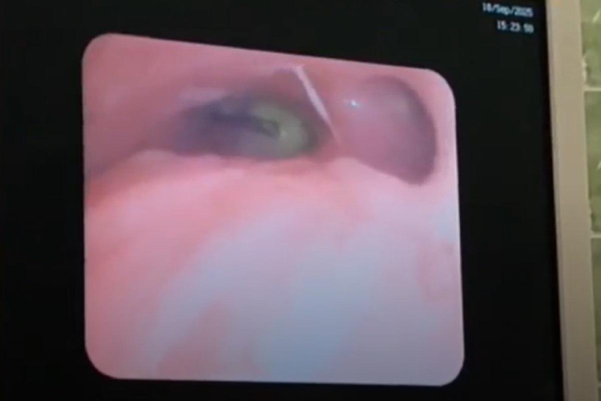 Двум школьникам в Ленобласти спасли легкие, удалив инородные тела из бронхов