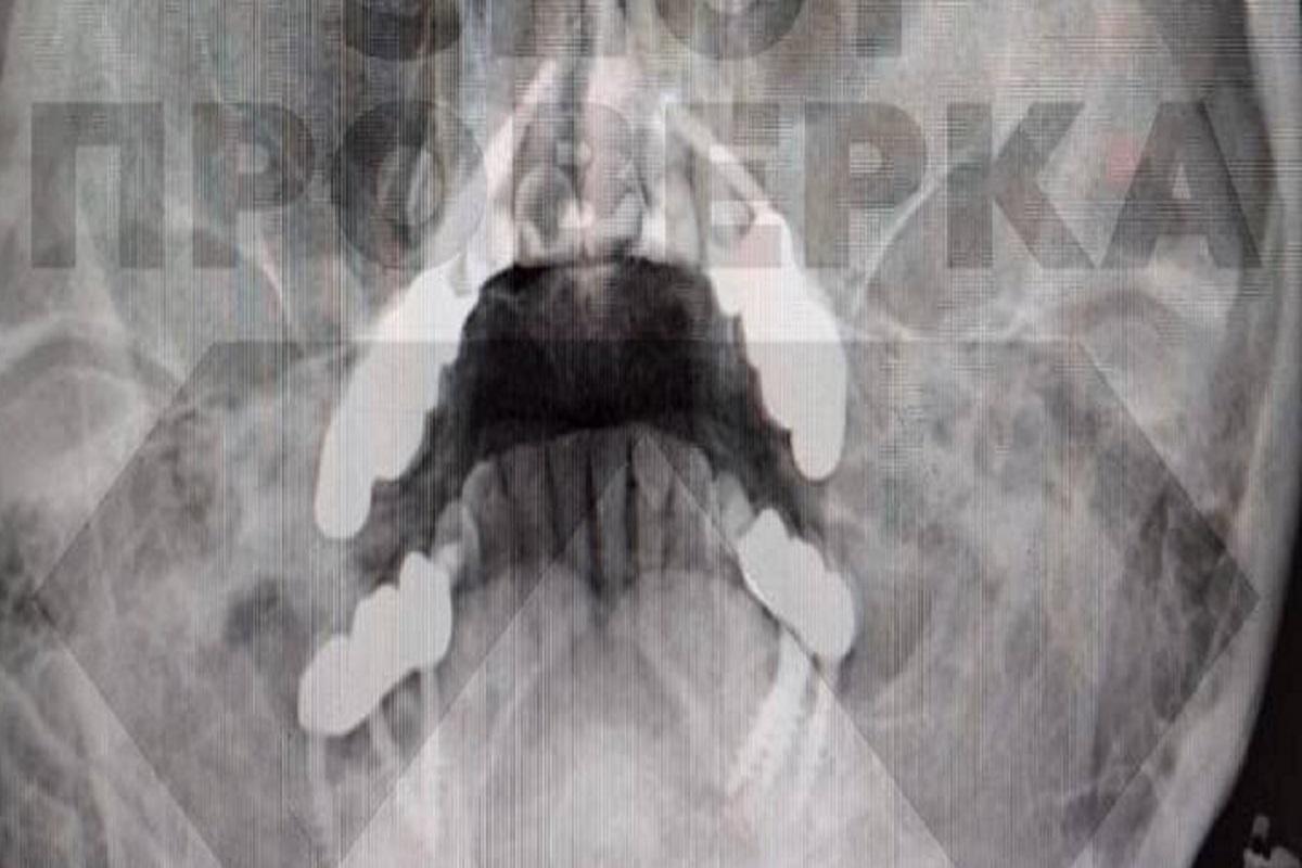 Жительнице Владимира стоматологи изуродовали лицо установкой имплантов