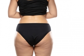 Endocrinologist Tananakina told why cellulite is very rare in men