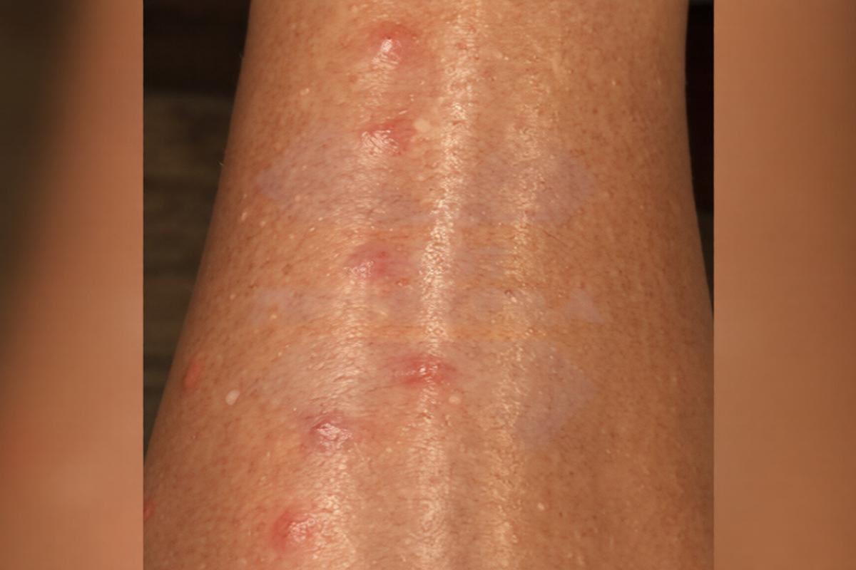 Российских туристов на Сейшелах атакуют песчаные мухи