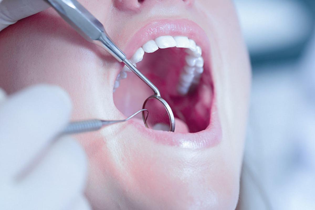 Scientists from the UK have revealed how to prevent tooth decay